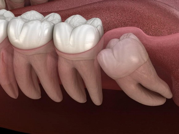 Điều gì xảy ra nếu răng khôn dài không được nhổ? Bác sĩ: 4 hiểm họa tiềm ẩn có thể ập đến, đừng bỏ qua